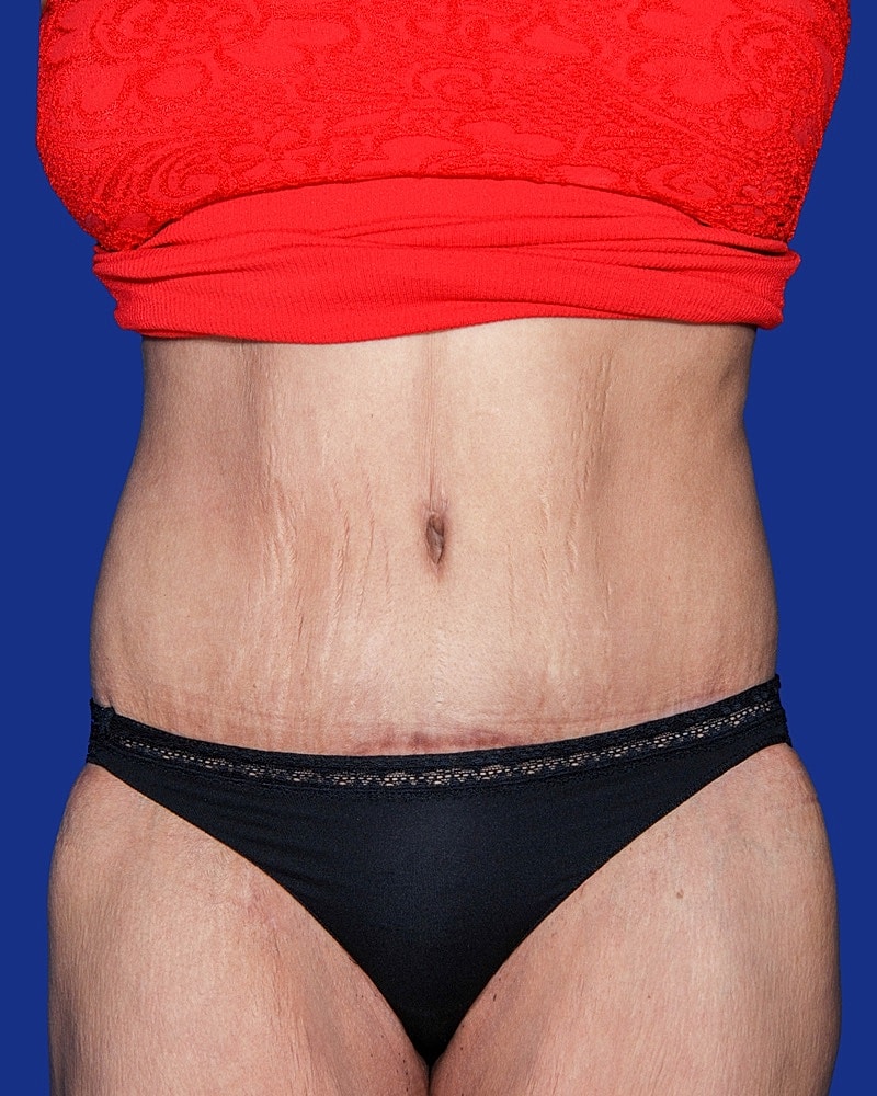Close-up of abdomen with stretch marks.