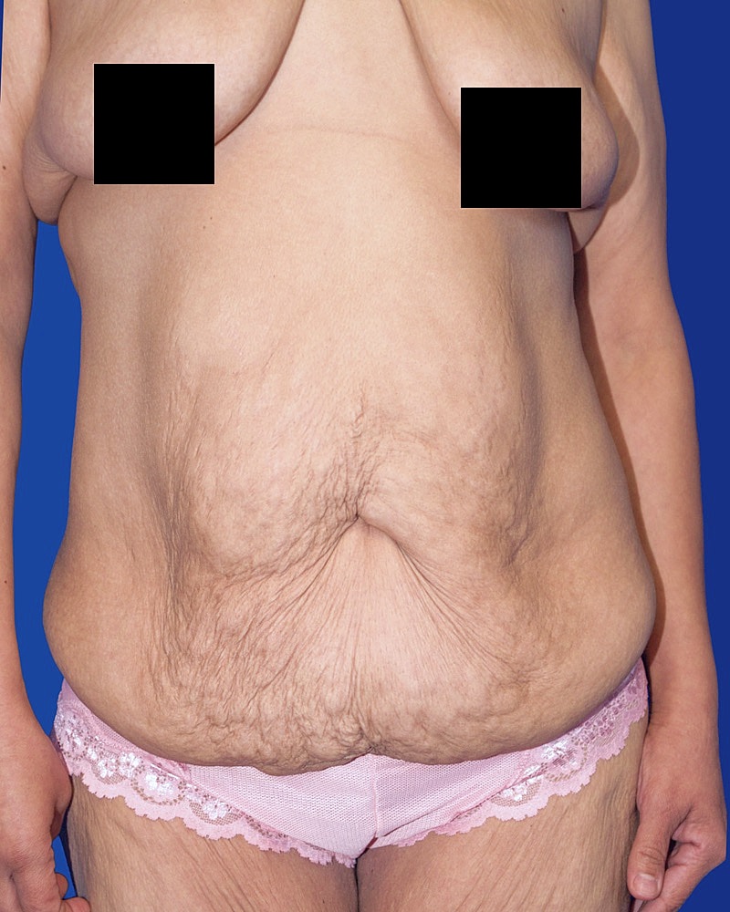 Body showing skin texture and scars.
