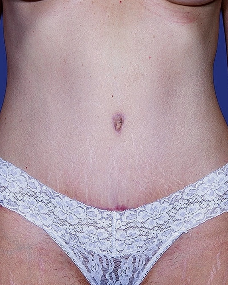 Lace underwear on a woman's abdomen.