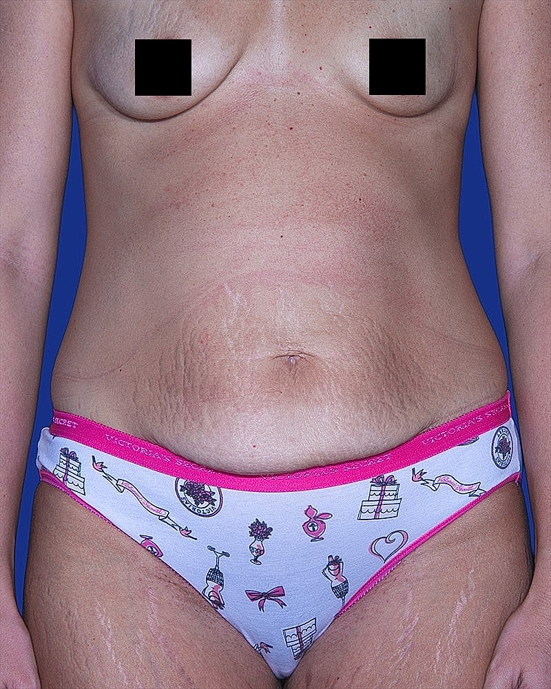 Body image with stretch marks in underwear.