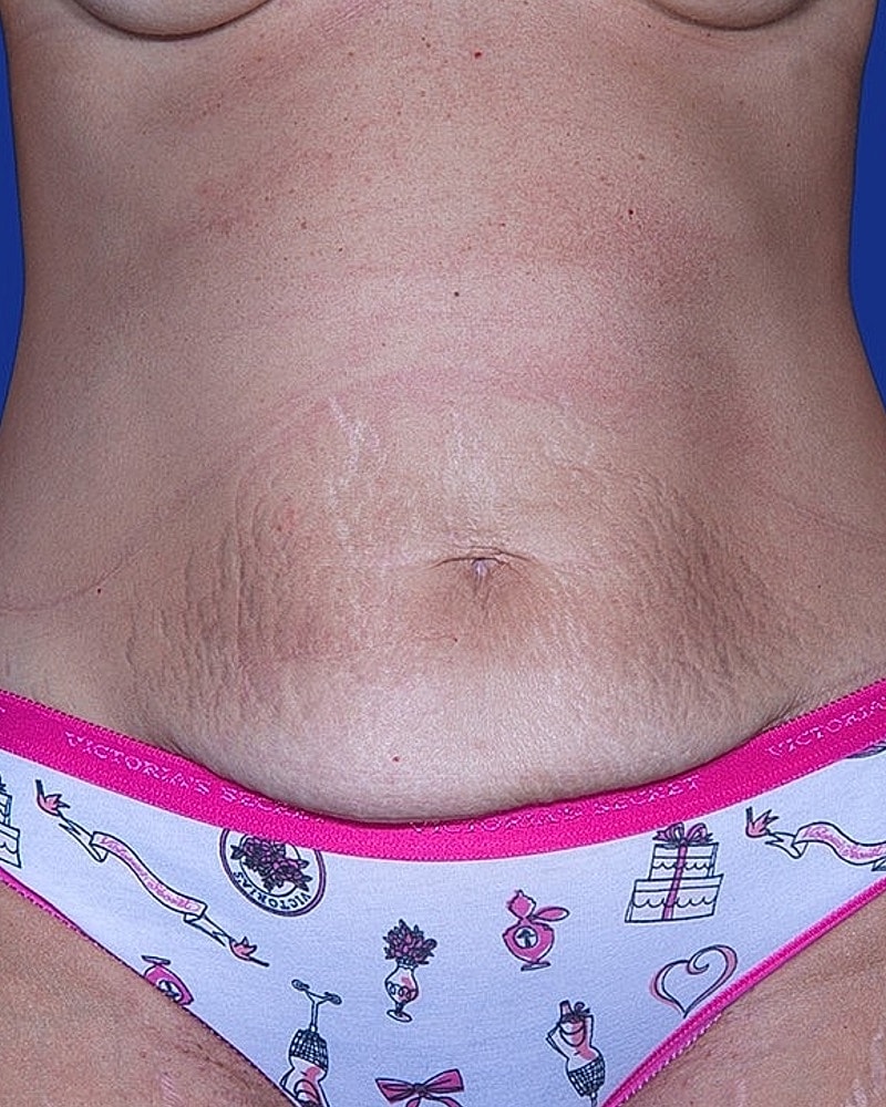 Close-up of abdomen with stretch marks.