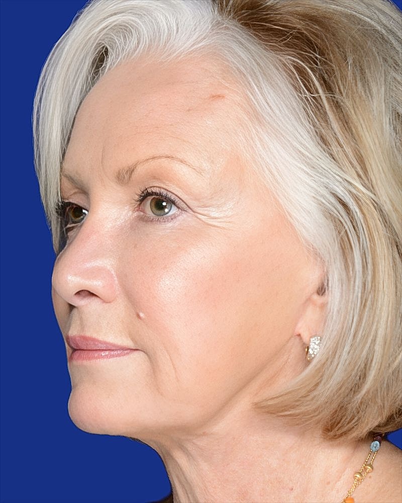 Profile of a woman with short blonde hair.