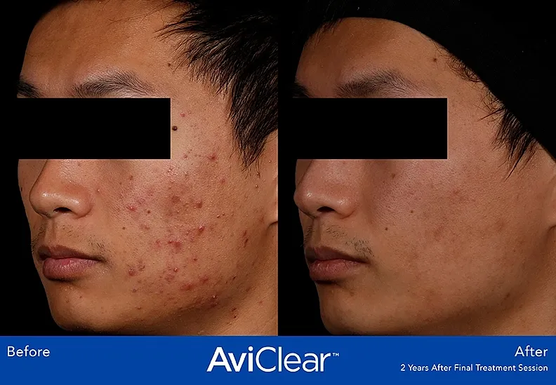 Acne treatment before and after comparison.