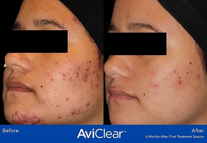 Acne treatment results before and after.