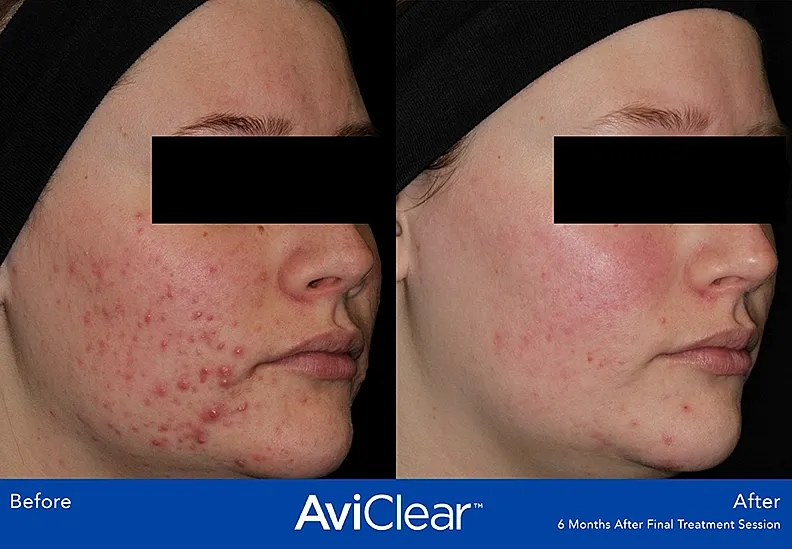 Before and after acne treatment results