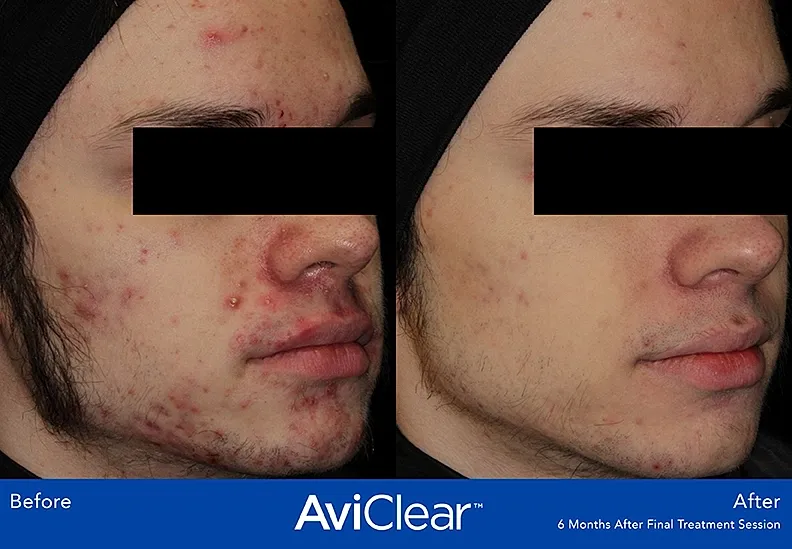 Acne treatment progress before and after photos.