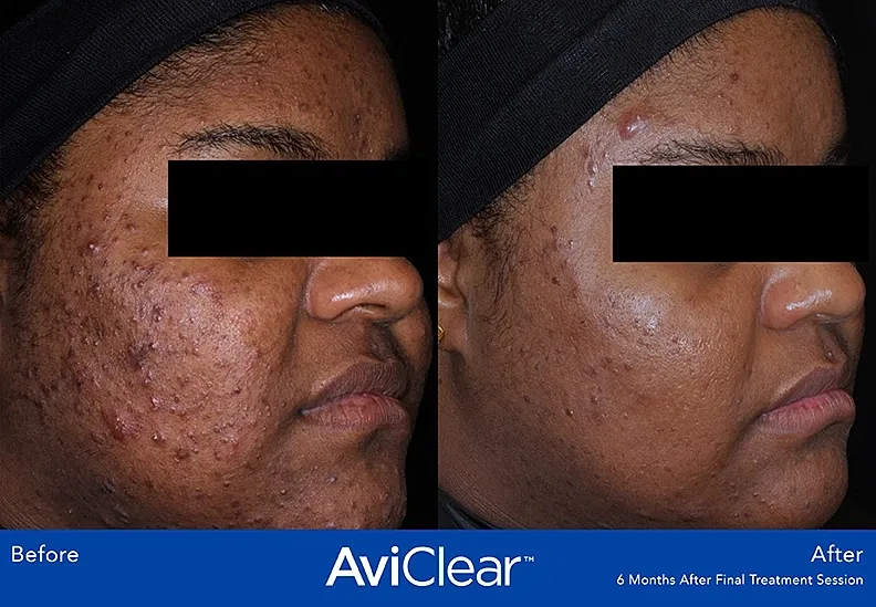 Acne treatment results before and after comparison.