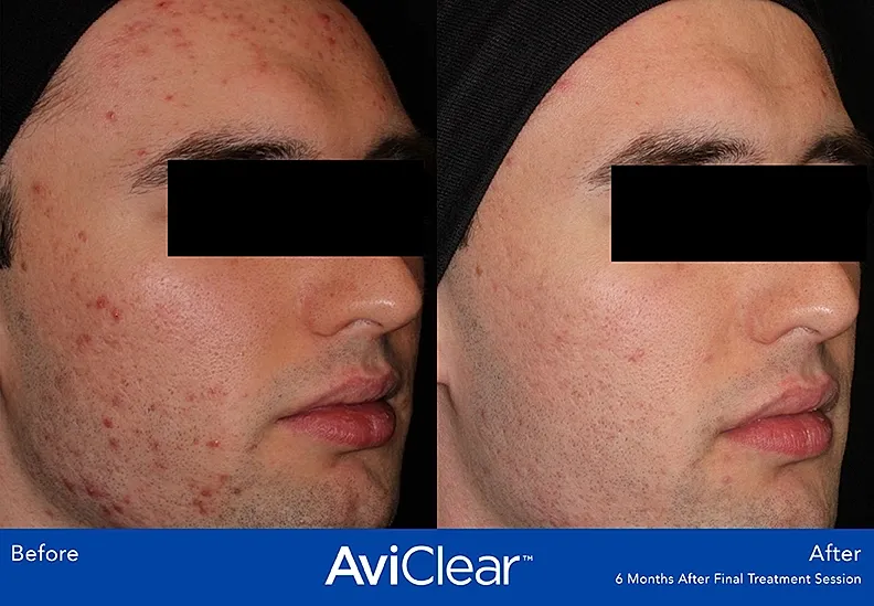 Before and after acne treatment results.