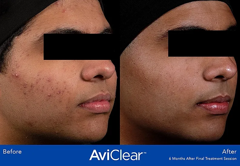 Before and after acne treatment results