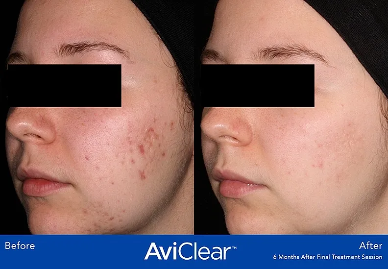 AviClear acne treatment before and after comparison.