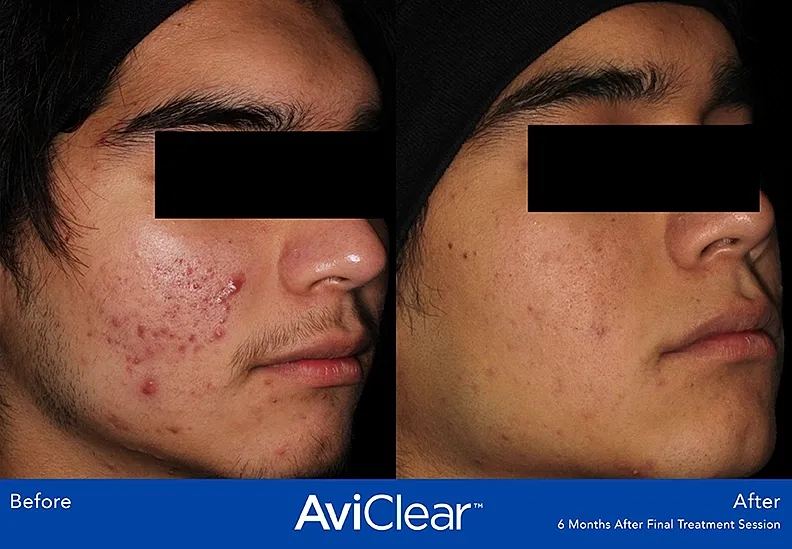 Acne treatment results before and after AviClear.