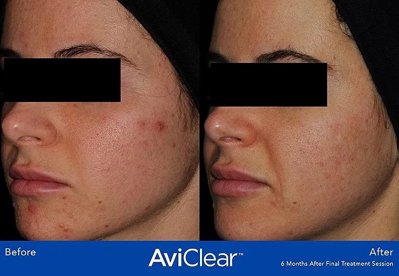 Before and after skin treatment results comparison.