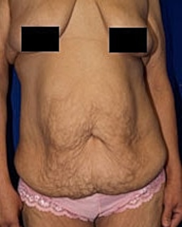 Abdominal skin with stretch marks.