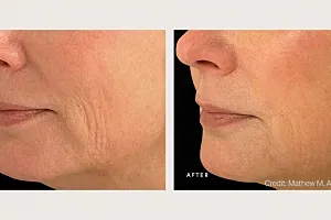 Before and after skin treatment comparison.
