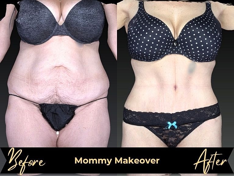 Before and after mommy makeover transformation results.