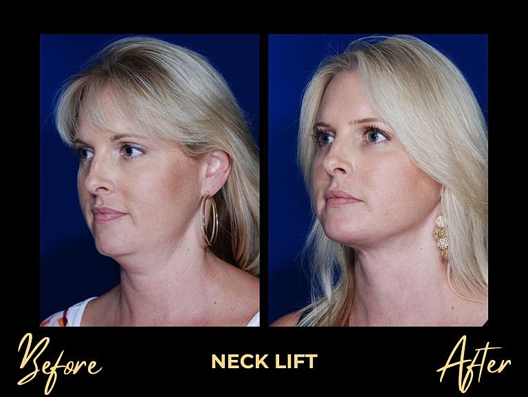 Neck lift before and after transformation image.