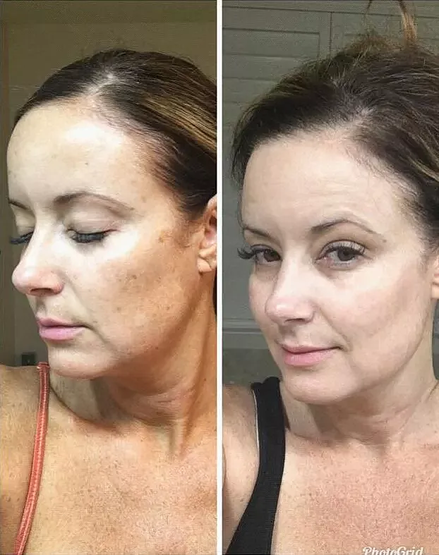 Before and after skincare treatment comparison