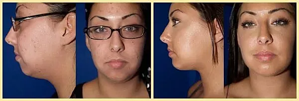Before and after facial transformation photos.