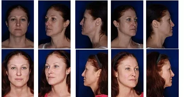 Patient before and after facial rejuvenation with multiple angles showing results