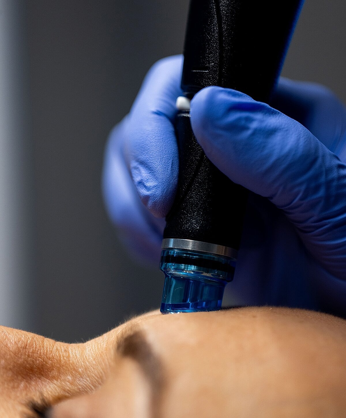 Microneedling procedure on client's skin.