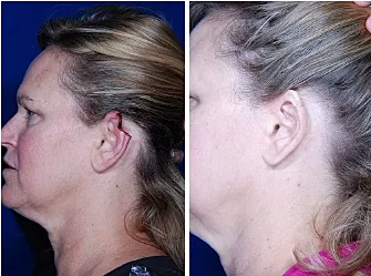 Before and after cosmetic procedure side profile comparison