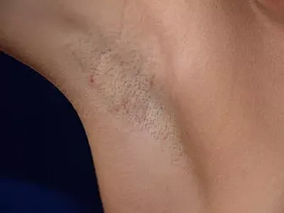 Close-up of underarm with hair growth.