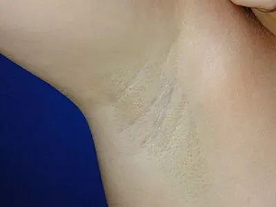 Close-up of skin with faint markings.