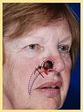 Patient with surgical markings on nose for skin cancer reconstruction procedure
