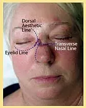 Skin cancer reconstruction patient showing improved facial symmetry and natural contours after surgery