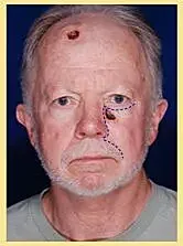 Skin cancer reconstruction patient result showing facial healing