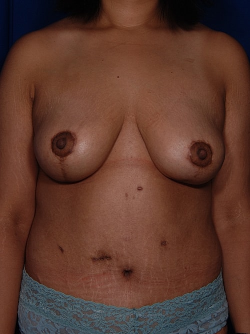 Breast Lift Before & After