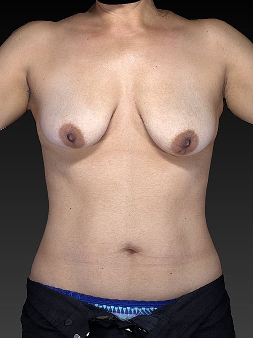Breast Lift Before & After