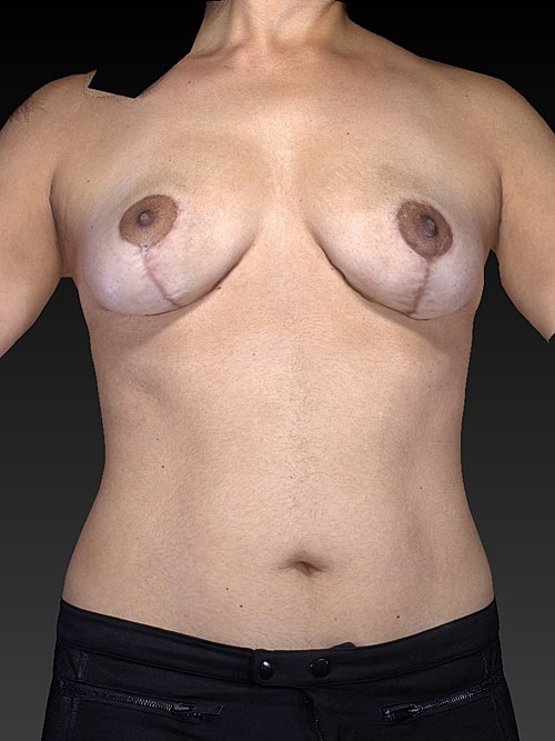 Breast Lift Before & After