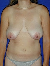 Breast Lift Before & After