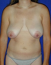 Breast Lift Before & After