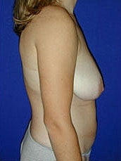 Breast Lift Before & After