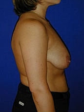 Breast Lift Before & After