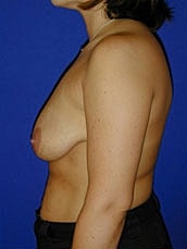 Breast Lift Before & After