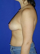 Breast Lift Before & After