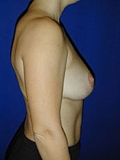 Breast Lift Before & After