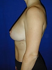 Breast Lift Before & After