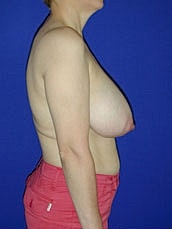 Breast Lift Before & After