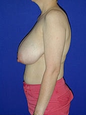 Breast Lift Before & After