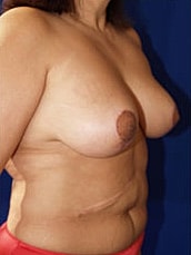 Breast Lift Before & After