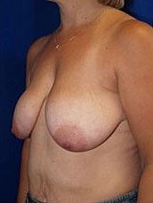 Breast Lift Before & After