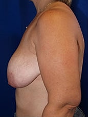 Breast Lift Before & After