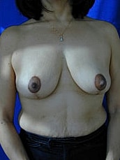 Breast Lift Before & After