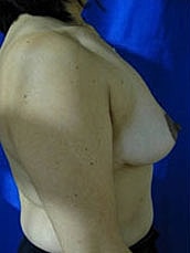Breast Lift Before & After