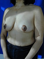 Breast Lift Before & After