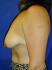 Breast Lift Before & After